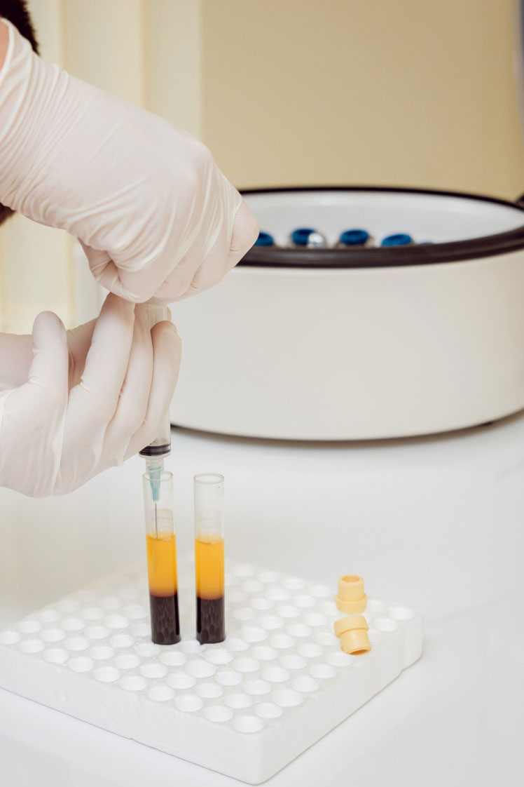 PRP (Platelet Rich Plasma)